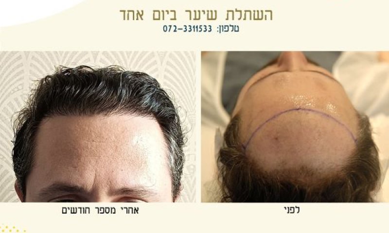 השתלות השיער במרפאתו של ד"ר שלום שאלתיאל - השקעה באיכות החיים שלך