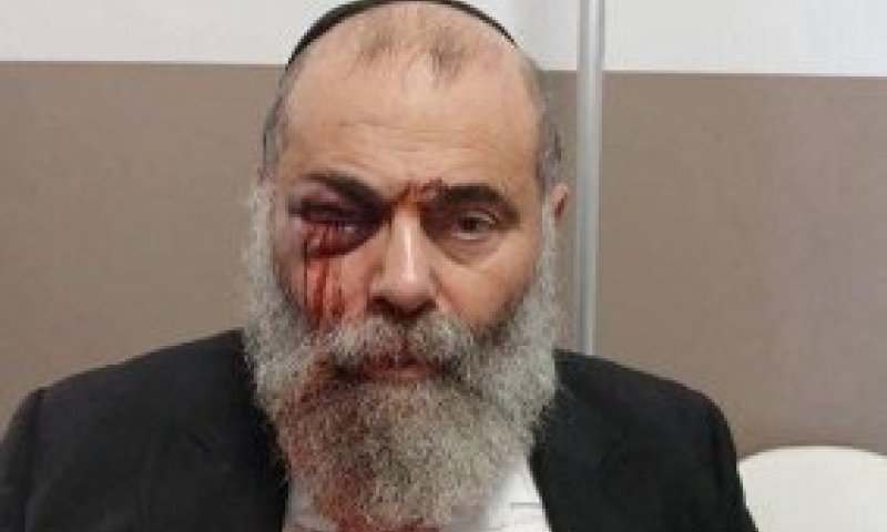 חרדי הותקף באלימות קשה בצרפת בדרכו חזרה מהמקווה